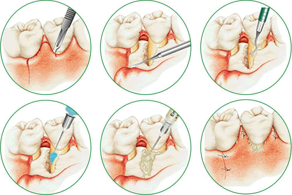 エムドゲインによる歯周組織再生療法