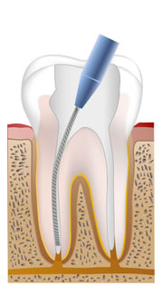根管内の感染物質を除去