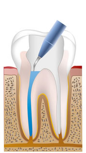 根管内の洗浄・殺菌