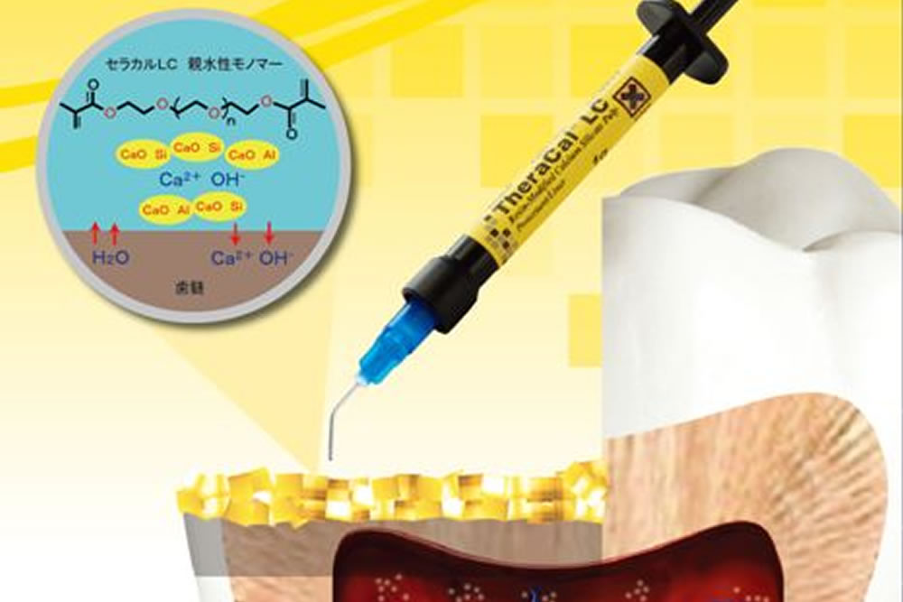 ニッケルチタンファイルの使用