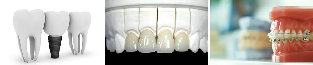 フルマウス(全顎的治療)