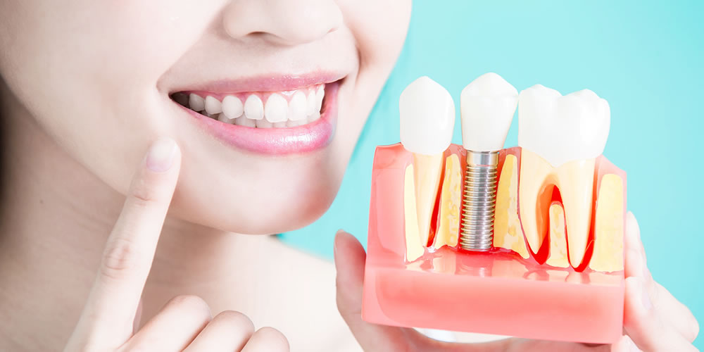 安心のインプラント一生涯保証・上部構造5年保証