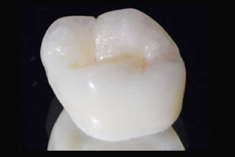 プレミアムセラミック