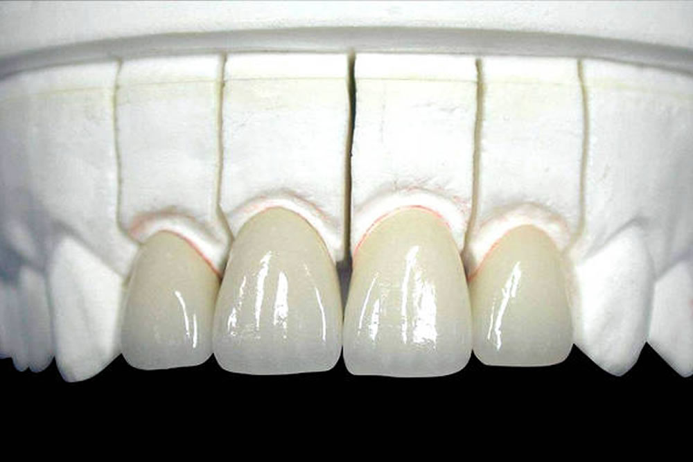 審美治療(セラミック治療)