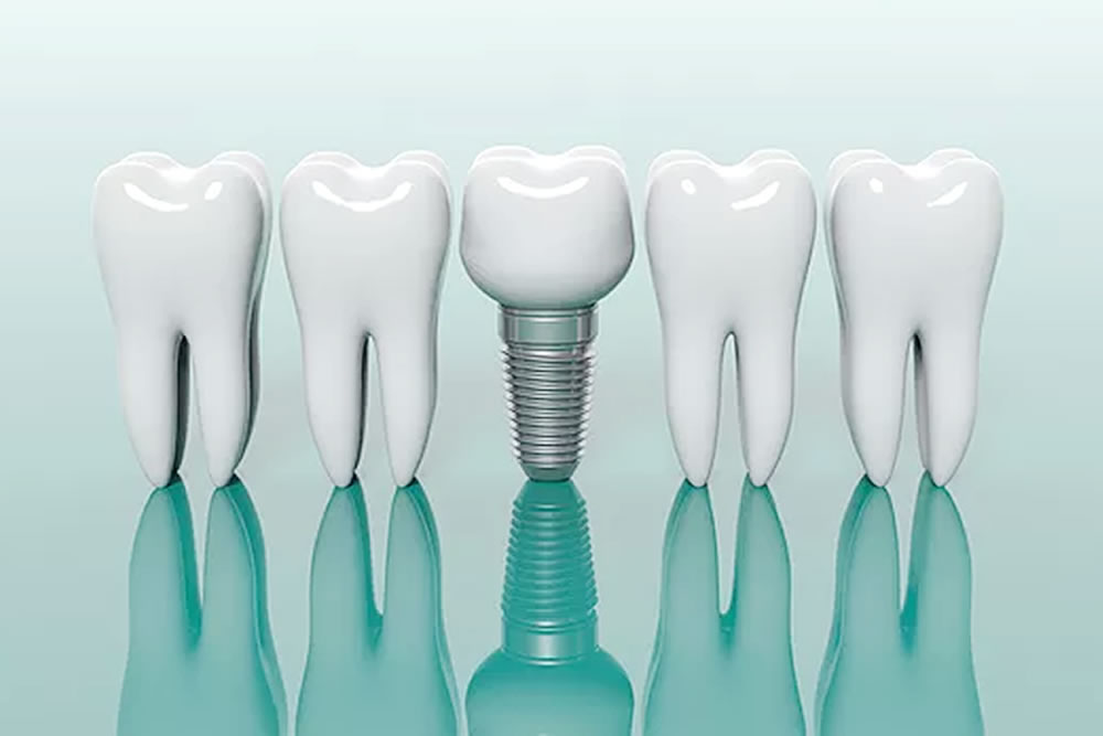 インプラント治療(抜歯即時埋入)