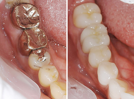 短期集中治療・フルマウス治療