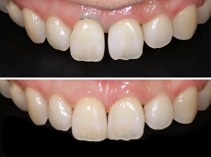 なるべく削らない治療