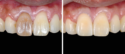 つめ物・かぶせ物