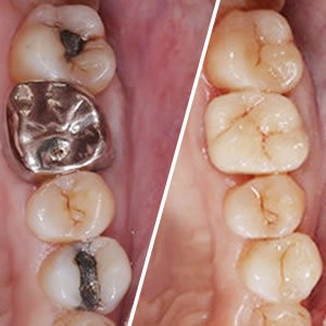 短期集中治療・フルマウス治療