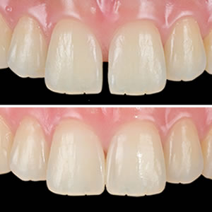 なるべく削らない治療