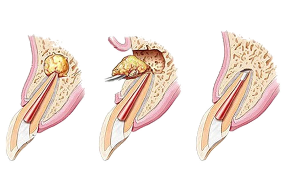 歯根端切除術の実施