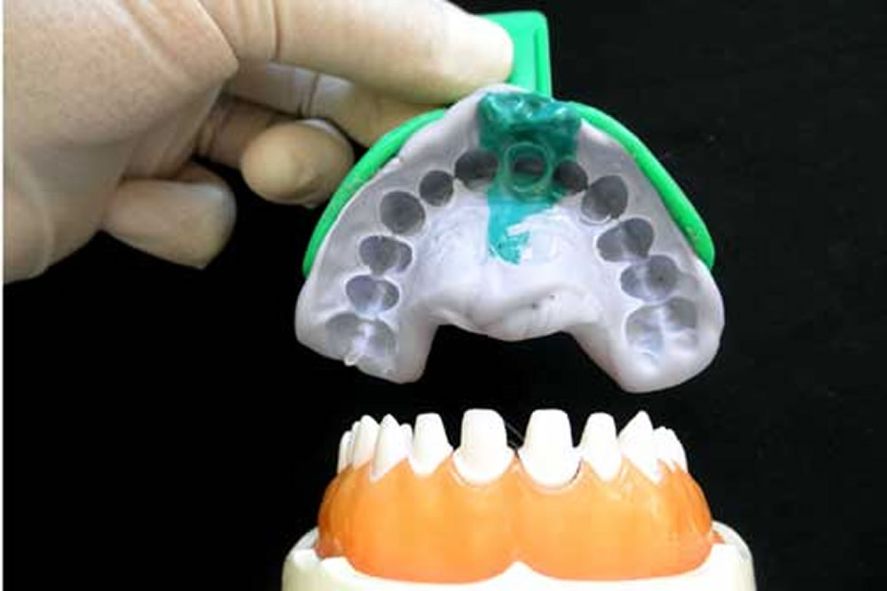 シリコン材による精密な型取り