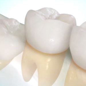 親知らずの抜歯