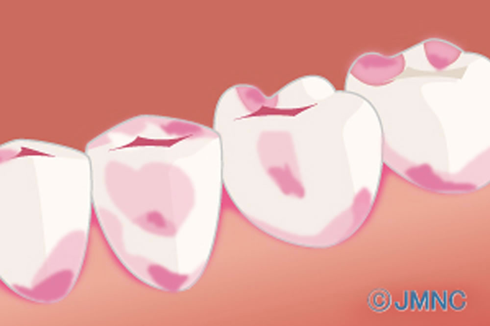 う蝕検知液を使用した虫歯の可視化