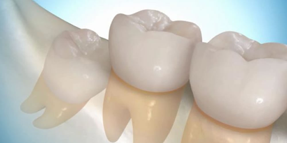 親知らずの抜歯