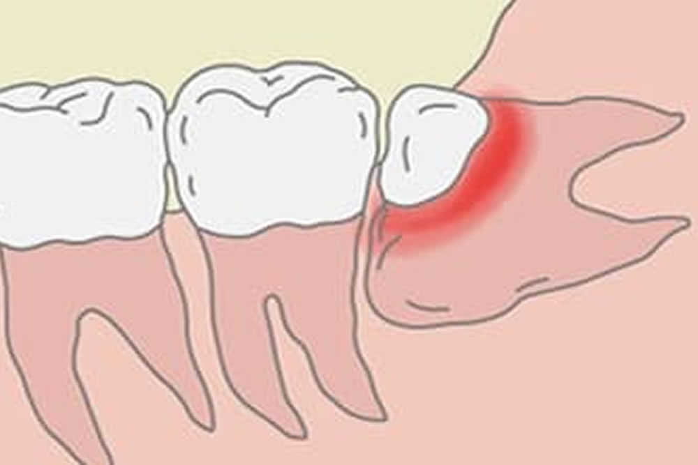 頻繁に智歯周囲炎を起こす